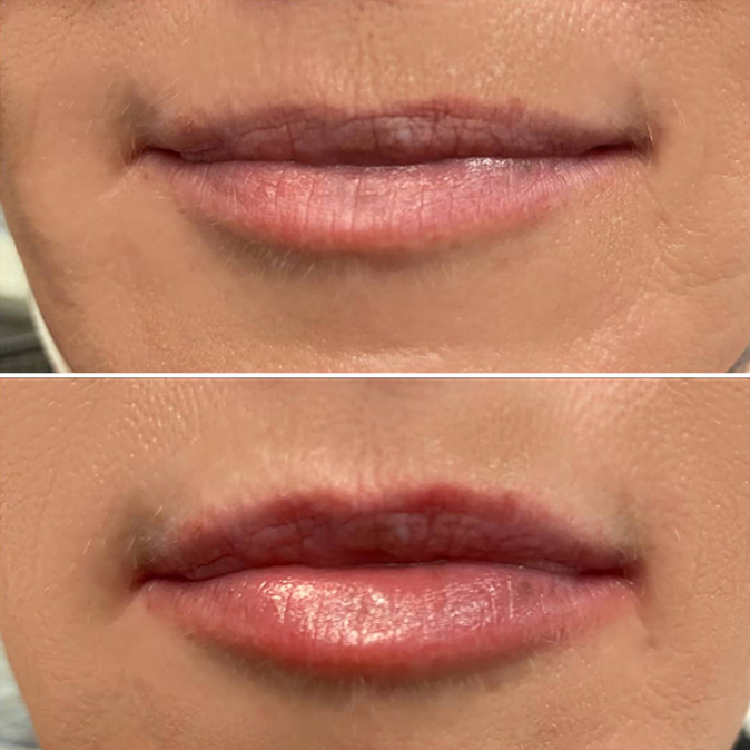 Lips-B&A2